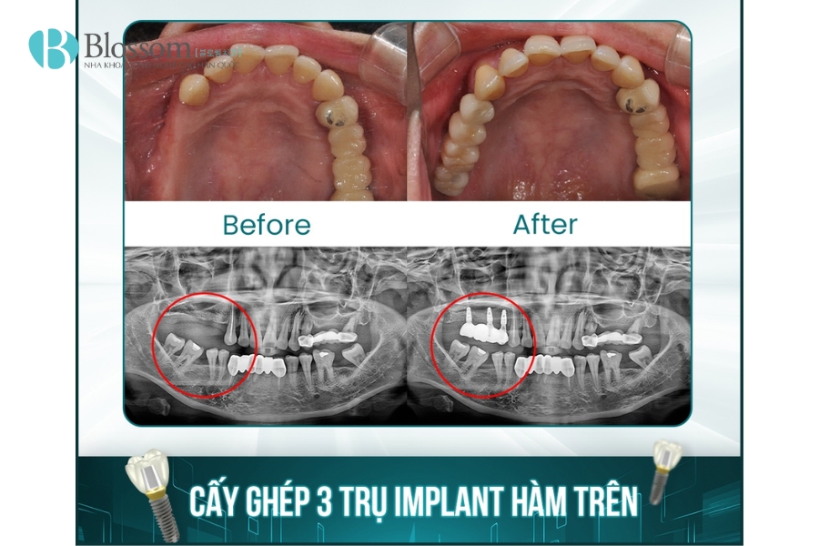 trong rang implant co di may bay duoc khong 9