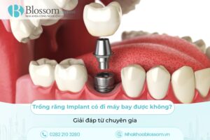 Trồng răng Implant có đi máy bay được không? Giải đáp từ chuyên gia