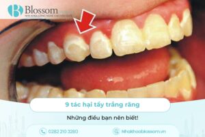 9 tác hại tẩy trắng răng và những điều bạn nên biết