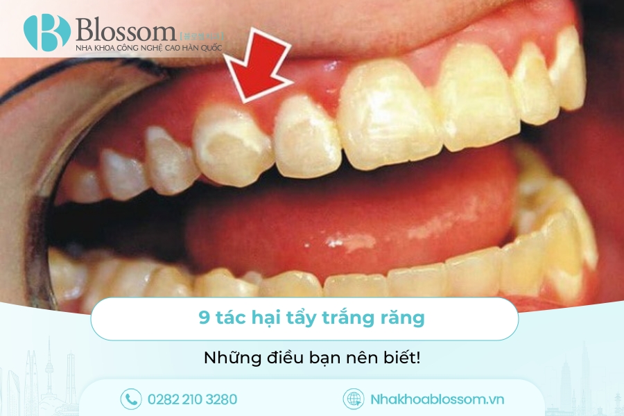 9 tác hại tẩy trắng răng và những điều bạn nên biết
