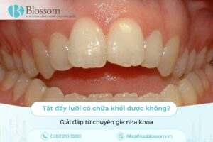 Tật đẩy lưỡi có chữa khỏi được không? Giải đáp từ chuyên gia nha khoa
