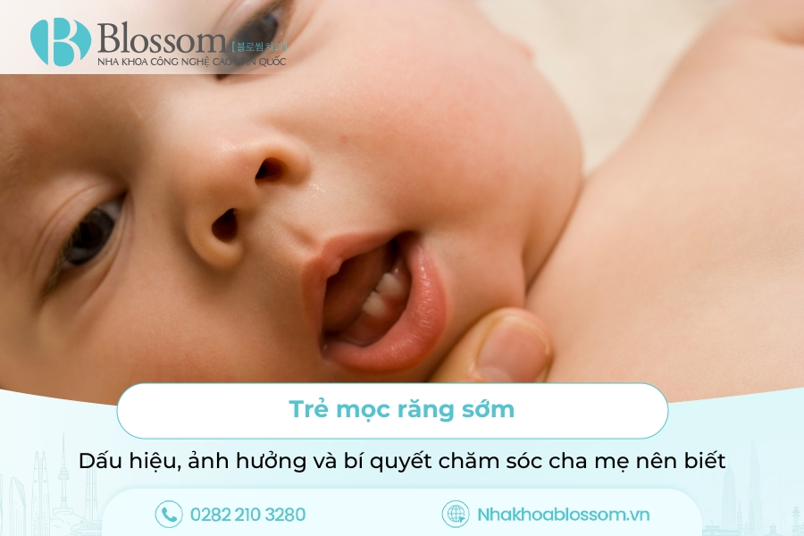 Trẻ mọc răng sớm: Dấu hiệu, ảnh hưởng và bí quyết chăm sóc cha mẹ nên biết