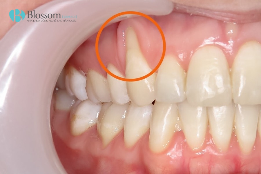 Tụt lợi có tự khỏi không? Nguyên nhân, triệu chứng và cách điều trị 1 tut loi co tu khoi khong 1