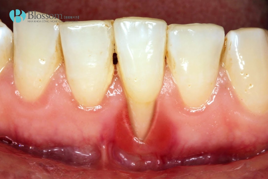 Tụt lợi có tự khỏi không? Nguyên nhân, triệu chứng và cách điều trị 2 tut loi co tu khoi khong 2