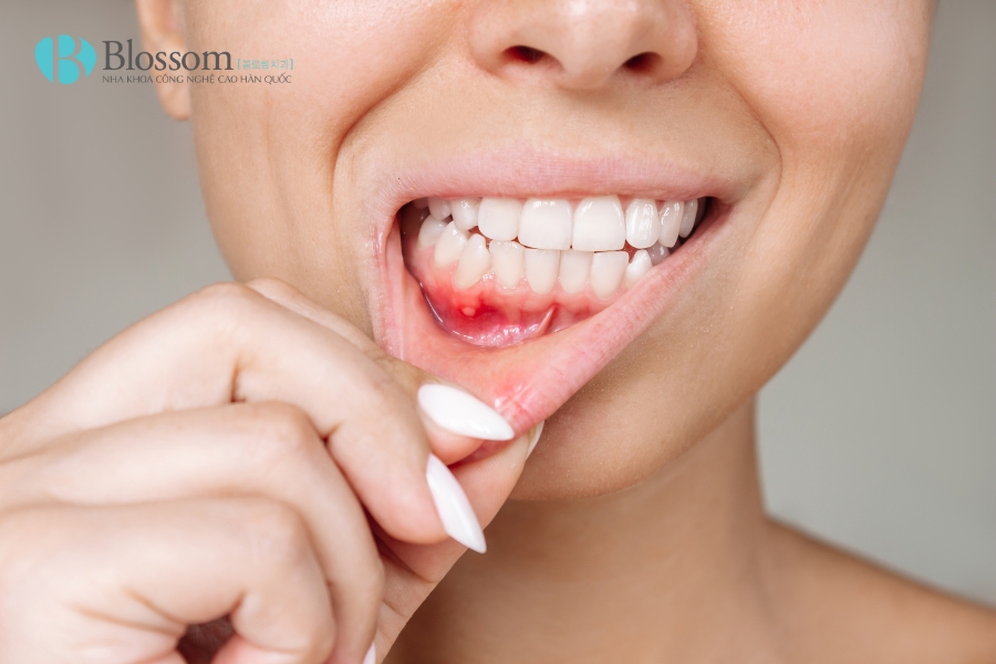 Tụt lợi có tự khỏi không? Nguyên nhân, triệu chứng và cách điều trị 3 tut loi co tu khoi khong 3