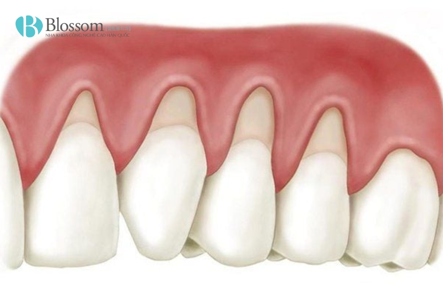 Tụt lợi có tự khỏi không? Nguyên nhân, triệu chứng và cách điều trị 5 tut loi co tu khoi khong 5