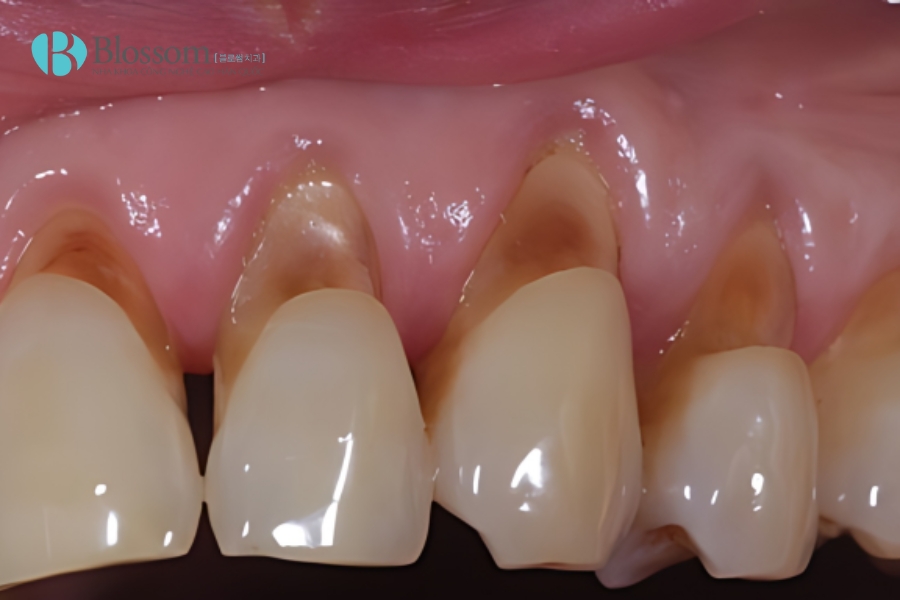 Tụt lợi có tự khỏi không? Nguyên nhân, triệu chứng và cách điều trị 6 tut loi co tu khoi khong 6