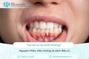 Tụt lợi có tự khỏi không? Nguyên nhân, triệu chứng và cách điều trị