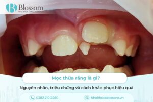 Mọc thừa răng là gì? Nguyên nhân, triệu chứng và cách khắc phục hiệu quả