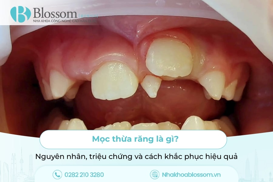 Mọc thừa răng là gì? Nguyên nhân, triệu chứng và cách khắc phục hiệu quả