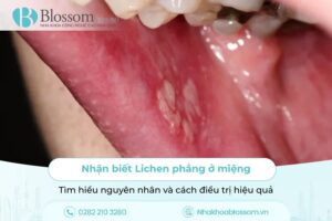 Nhận biết Lichen phẳng ở miệng: Tìm hiểu nguyên nhân và cách điều trị hiệu quả 12 Nhận biết Lichen phẳng ở miệng: Tìm hiểu nguyên nhân và cách điều trị hiệu quả