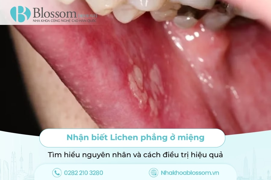 Nhận biết Lichen phẳng ở miệng: Tìm hiểu nguyên nhân và cách điều trị hiệu quả