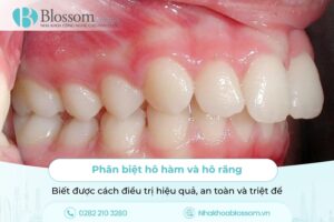 Phân biệt hô hàm và hô răng. Biết được cách điều trị hiệu quả, an toàn và triệt để