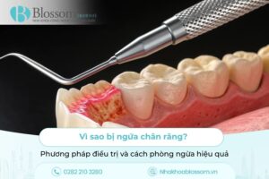 Vì sao bị ngứa chân răng? Phương pháp điều trị và cách phòng ngừa hiệu quả