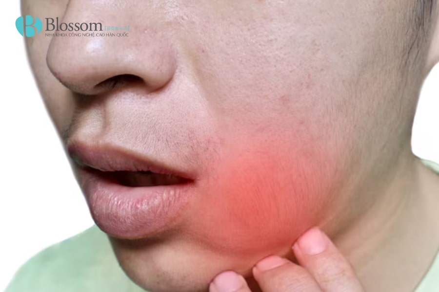 Đau răng sưng má: Nguyên nhân, mức độ nguy hiểm và cách điều trị hiệu quả 3 dau rang sung ma 3 min 1
