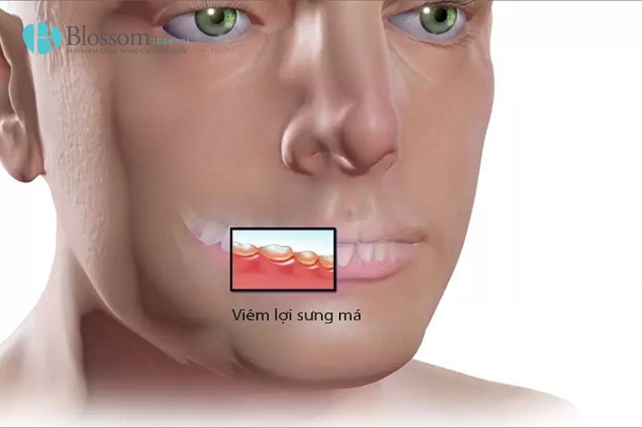 Đau răng sưng má: Nguyên nhân, mức độ nguy hiểm và cách điều trị hiệu quả 4 dau rang sung ma 4 min 1