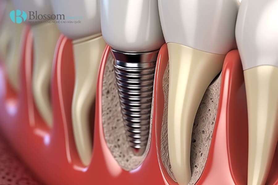 Top 12 địa chỉ trồng Implant uy tín tại TP.HCM 1 dia chi trong implant uy tin 1