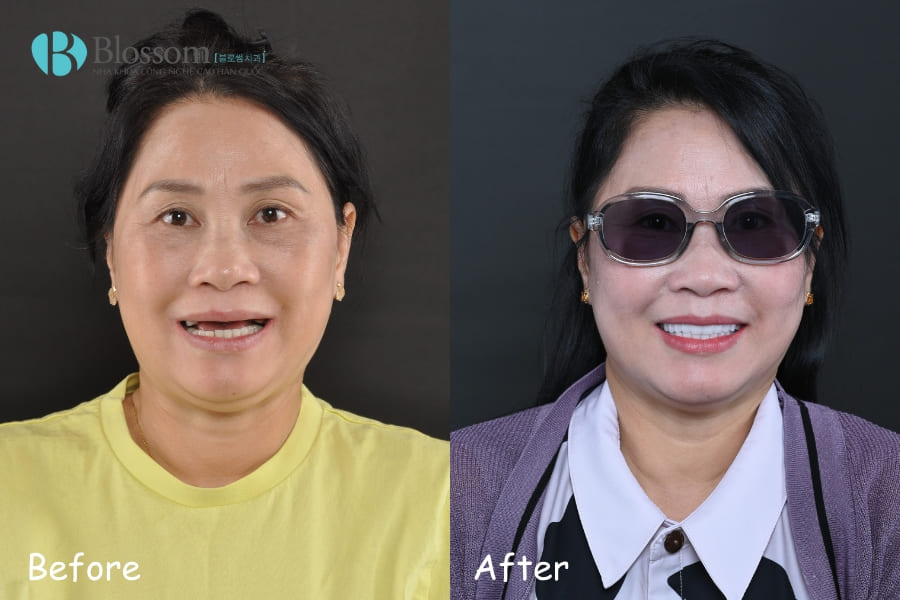 Top 12 địa chỉ trồng Implant uy tín tại TP.HCM 8 dia chi trong implant uy tin 13