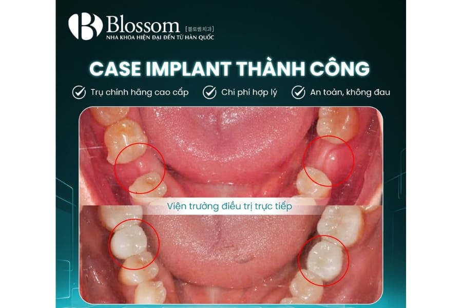 Top 12 địa chỉ trồng Implant uy tín tại TP.HCM 7 dia chi trong implant uy tin 3