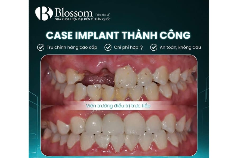 Top 12 địa chỉ trồng Implant uy tín tại TP.HCM 11 dia chi trong implant uy tin 6