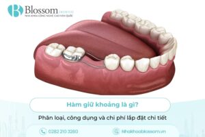 Hàm giữ khoảng là gì? Phân loại, công dụng và chi phí lắp đặt chi tiết