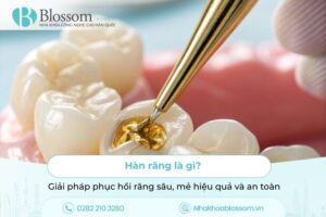 Hàn răng: Giải pháp phục hồi răng sâu, mẻ hiệu quả và an toàn