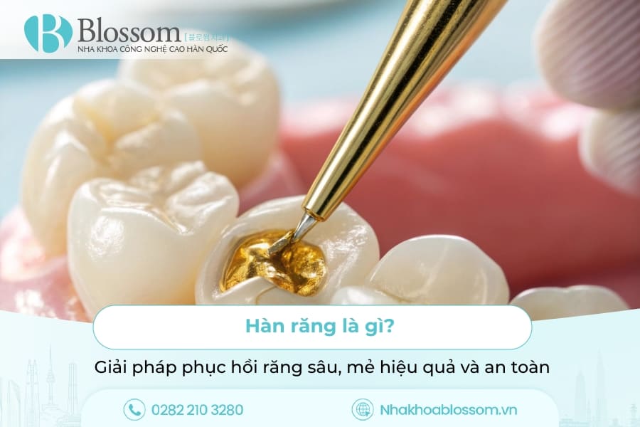 Hàn răng: Giải pháp phục hồi răng sâu, mẻ hiệu quả và an toàn