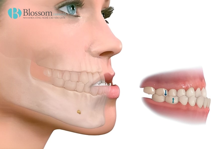 Hô hàm dưới là gì? Nguyên nhân, tác hại và cách khắc phục hiệu quả 1 ho ham duoi 1 min 1