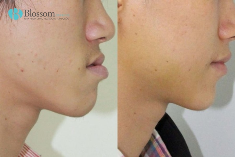 Hô hàm dưới là gì? Nguyên nhân, tác hại và cách khắc phục hiệu quả 2 ho ham duoi 2 min 1