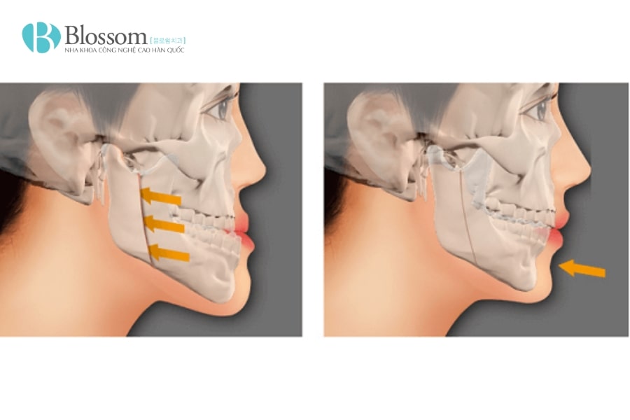 Hô hàm dưới là gì? Nguyên nhân, tác hại và cách khắc phục hiệu quả 3 ho ham duoi 3 min 1