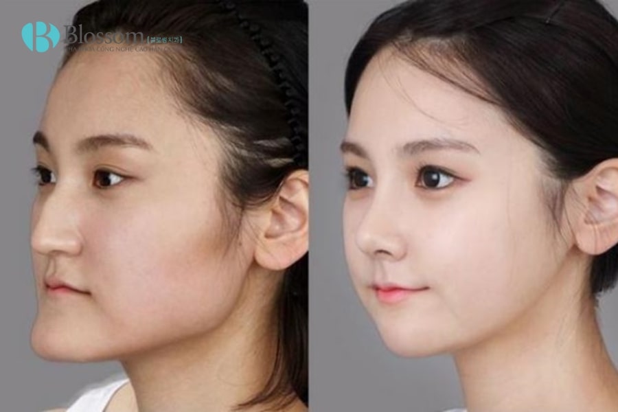 Hô hàm dưới là gì? Nguyên nhân, tác hại và cách khắc phục hiệu quả 5 ho ham duoi 5 min 1