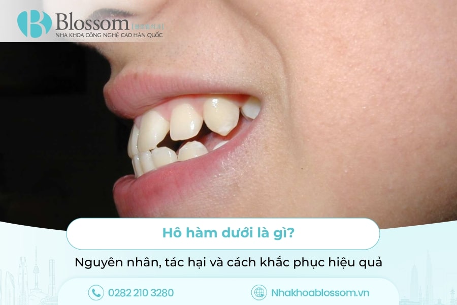 Hô hàm dưới là gì? Nguyên nhân, tác hại và cách khắc phục hiệu quả