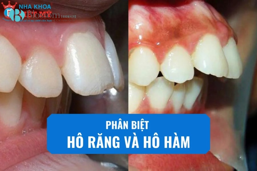 Phân biệt hô hàm và hô răng. Biết được cách điều trị hiệu quả, an toàn và triệt để 1 ho ham va ho rang 1 min