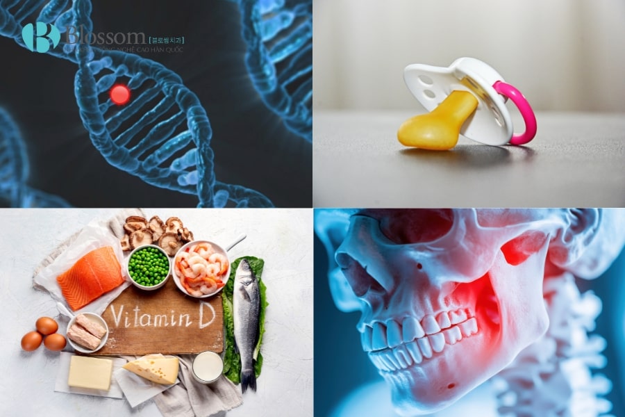 Phân biệt hô hàm và hô răng. Biết được cách điều trị hiệu quả, an toàn và triệt để 2 ho ham va ho rang 2 min