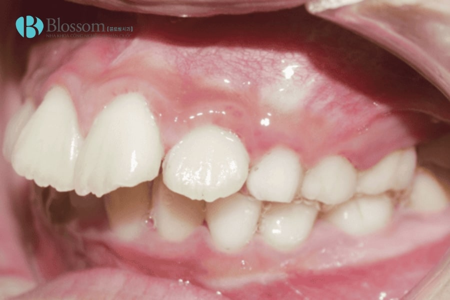 Phân biệt hô hàm và hô răng. Biết được cách điều trị hiệu quả, an toàn và triệt để 3 ho ham va ho rang 3 min