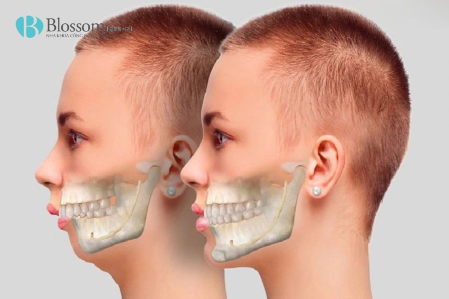 Phân biệt hô hàm và hô răng. Biết được cách điều trị hiệu quả, an toàn và triệt để 5 ho ham va ho rang 5 min