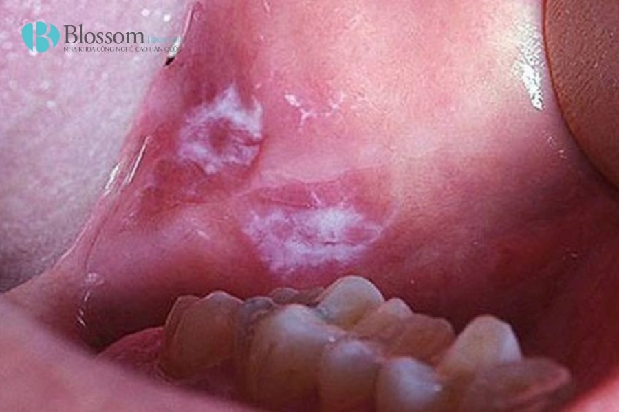 Nhận biết Lichen phẳng ở miệng: Tìm hiểu nguyên nhân và cách điều trị hiệu quả 6 lichen phang o mieng 1 min