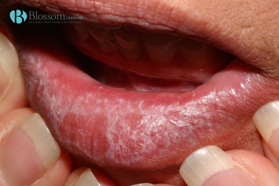 Nhận biết Lichen phẳng ở miệng: Tìm hiểu nguyên nhân và cách điều trị hiệu quả 2 lichen phang o mieng 2 min