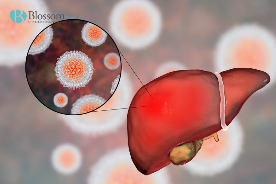 Nhận biết Lichen phẳng ở miệng: Tìm hiểu nguyên nhân và cách điều trị hiệu quả 3 lichen phang o mieng 3 min