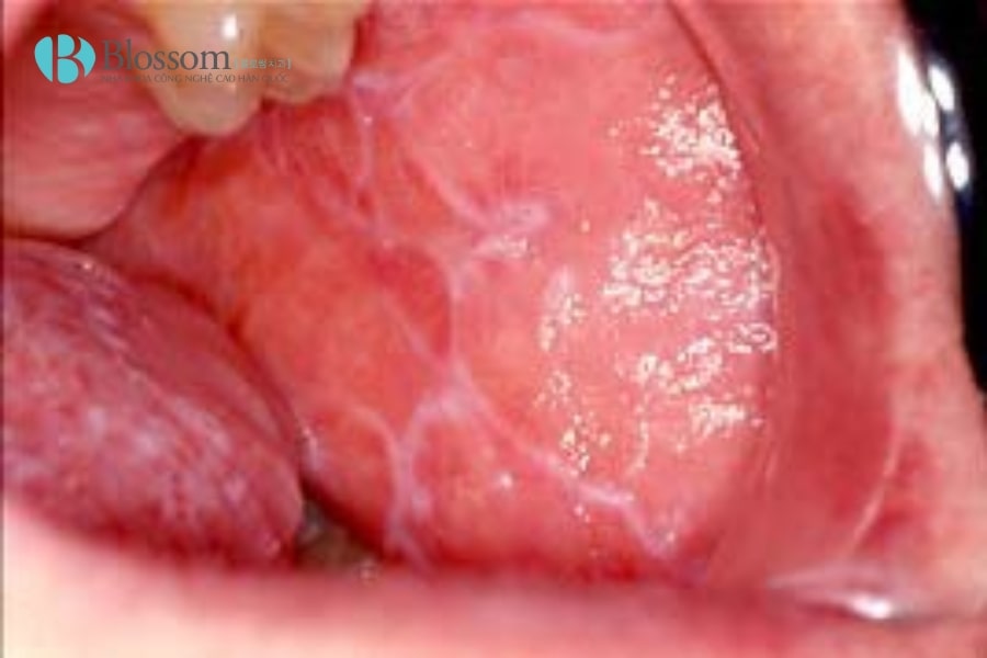 Nhận biết Lichen phẳng ở miệng: Tìm hiểu nguyên nhân và cách điều trị hiệu quả 4 lichen phang o mieng 4 min