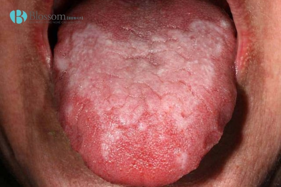 Nhận biết Lichen phẳng ở miệng: Tìm hiểu nguyên nhân và cách điều trị hiệu quả 5 lichen phang o mieng 5 min