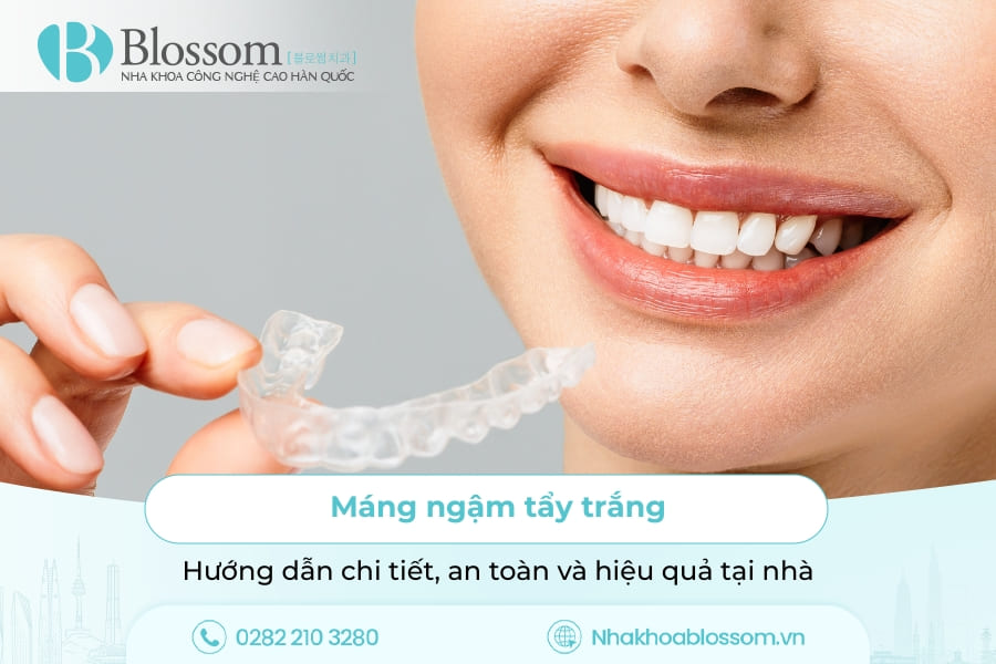 Máng ngậm tẩy trắng: Hướng dẫn chi tiết, an toàn và hiệu quả tại nhà