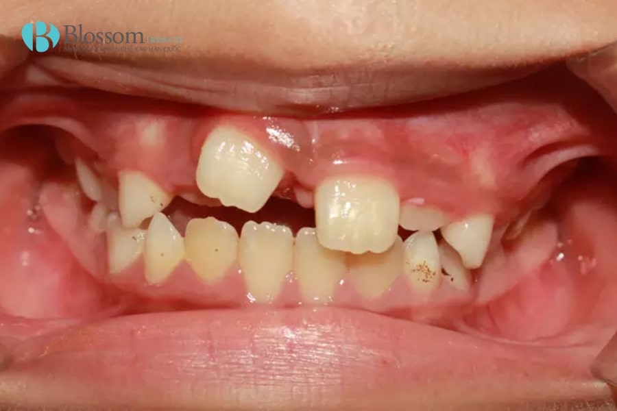 Mọc thừa răng là gì? Nguyên nhân, triệu chứng và cách khắc phục hiệu quả 1 moc thua rang 1 min