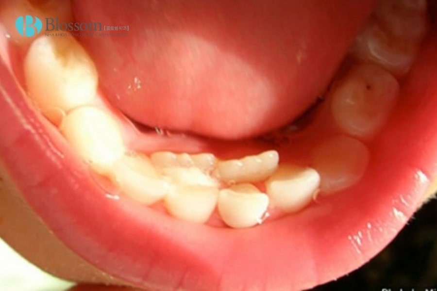 Mọc thừa răng là gì? Nguyên nhân, triệu chứng và cách khắc phục hiệu quả 2 moc thua rang 2 min