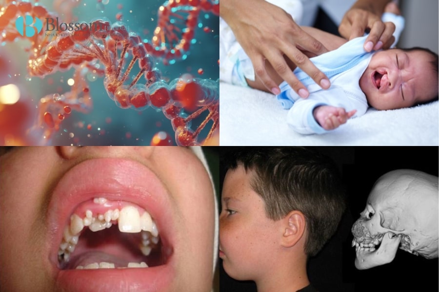 Mọc thừa răng là gì? Nguyên nhân, triệu chứng và cách khắc phục hiệu quả 3 moc thua rang 3 min