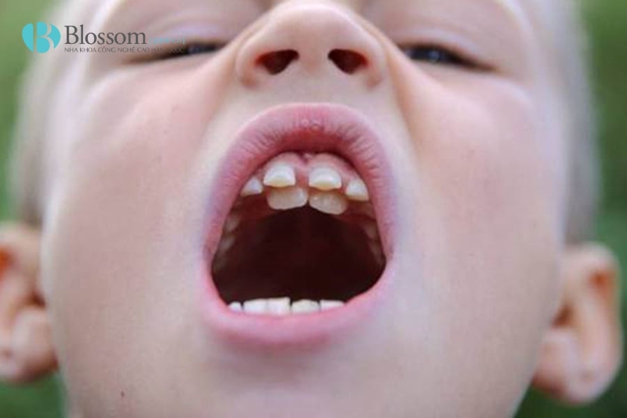 Mọc thừa răng là gì? Nguyên nhân, triệu chứng và cách khắc phục hiệu quả 4 moc thua rang 4 min