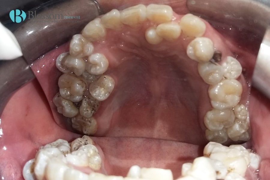 Mọc thừa răng là gì? Nguyên nhân, triệu chứng và cách khắc phục hiệu quả 5 moc thua rang 5 min