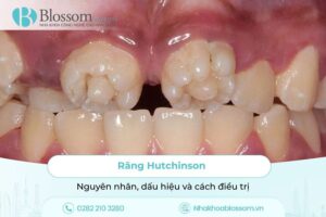 Răng Hutchinson: Nguyên nhân, dấu hiệu và cách điều trị