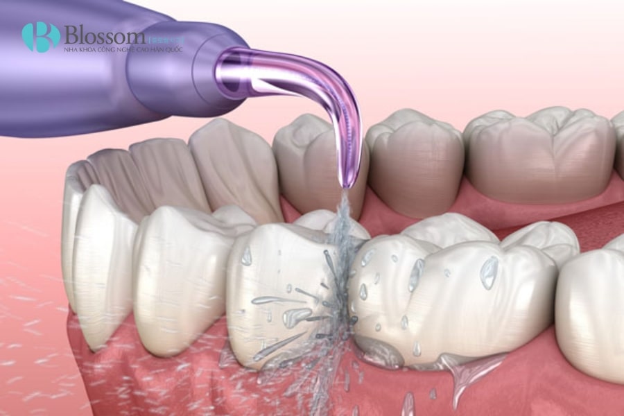 Hướng dẫn cách sử dụng tăm nước đúng cách, hiệu quả và an toàn cho răng miệng 1 su dung tam nuoc 1 min