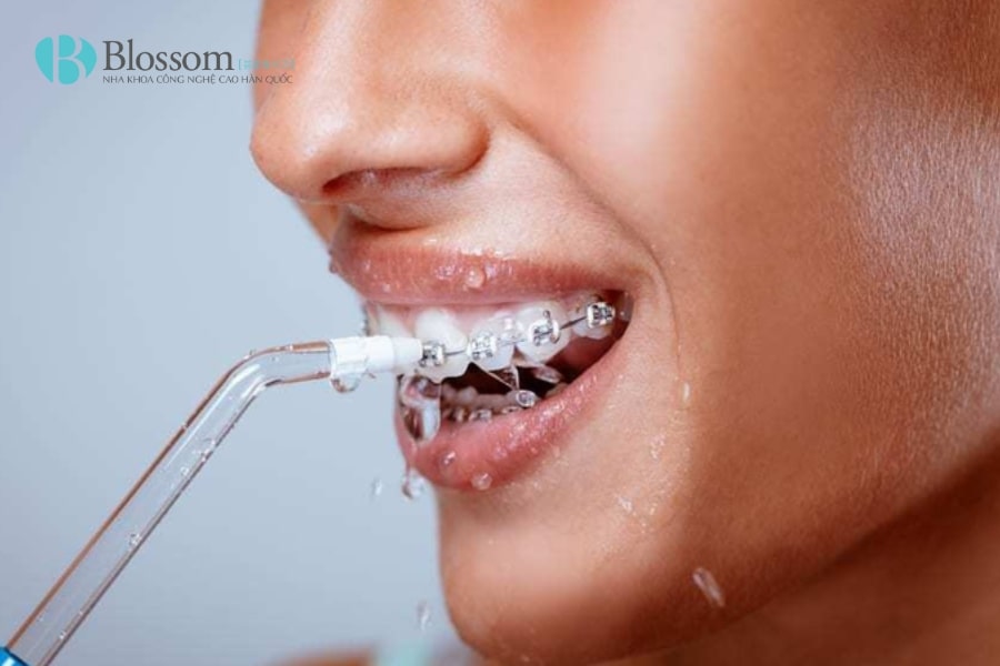 Hướng dẫn cách sử dụng tăm nước đúng cách, hiệu quả và an toàn cho răng miệng 2 su dung tam nuoc 2 min